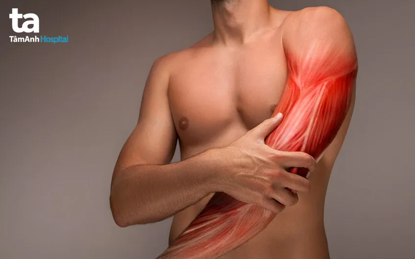 Minh họa tình trạng căng cơ