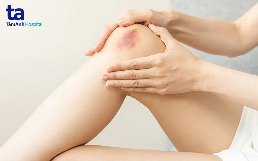 Vết bầm tím trên da